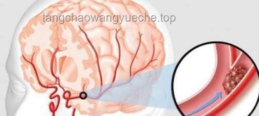 女生突发脑出血后竟“失去”说英语能力：症状解析与应对